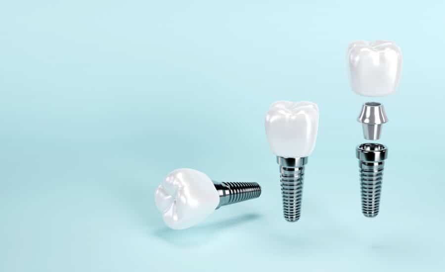 Jak dbać o implanty zębowe